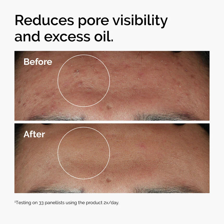 Niacinamide 10% + Zinc 1% | THE ORDINARY