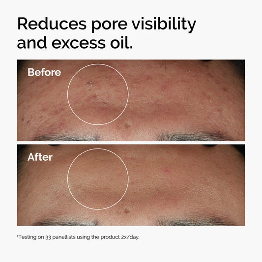 Niacinamide 10% + Zinc 1% | THE ORDINARY